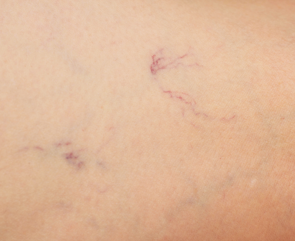 can-spider-veins-be-permanently-removed