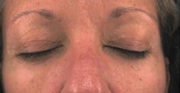 Fractional C02 Before & After Image