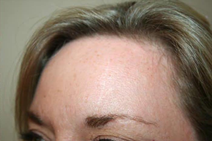 RF Microneedling Before & After Image
